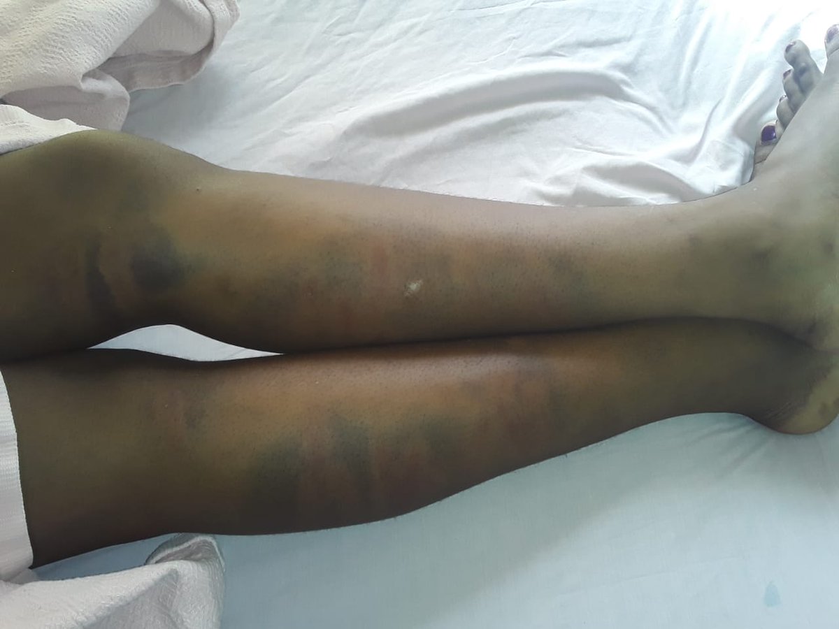 vezi_mamiya's tweet image. Last night I got a call and was sent these pictures of a Grade 10 female learner who was beaten up by a male teacher because she was walking slow (due to period pains). This occurred on Monday and she was taken to the doctor who discharged her on that same day.