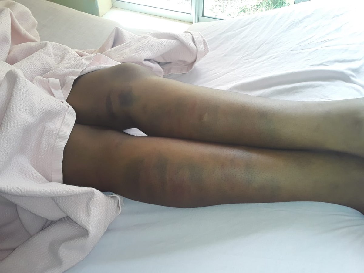 vezi_mamiya's tweet image. Last night I got a call and was sent these pictures of a Grade 10 female learner who was beaten up by a male teacher because she was walking slow (due to period pains). This occurred on Monday and she was taken to the doctor who discharged her on that same day.
