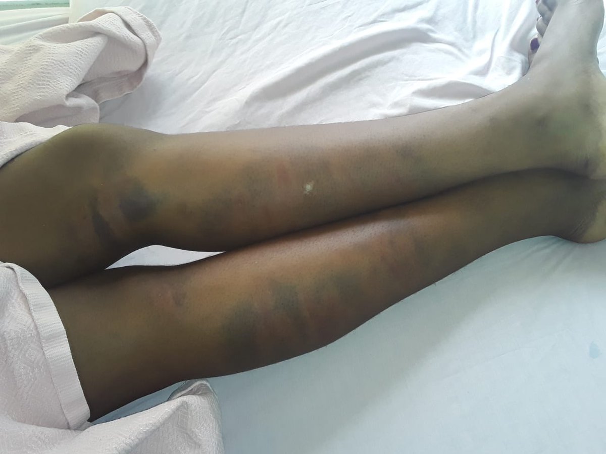 vezi_mamiya's tweet image. Last night I got a call and was sent these pictures of a Grade 10 female learner who was beaten up by a male teacher because she was walking slow (due to period pains). This occurred on Monday and she was taken to the doctor who discharged her on that same day.