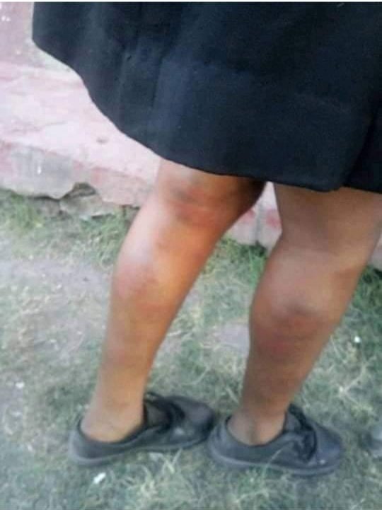 vezi_mamiya's tweet image. Last night I got a call and was sent these pictures of a Grade 10 female learner who was beaten up by a male teacher because she was walking slow (due to period pains). This occurred on Monday and she was taken to the doctor who discharged her on that same day.