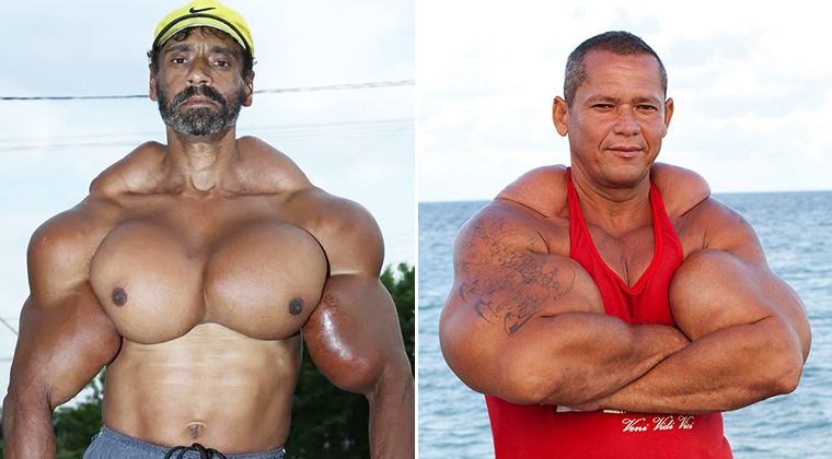 alanemtage's tweet image. The Weird World of Synthol Bodybuilders buff.ly/2EVvnap #bodybuilding #synthol #dysmorphia