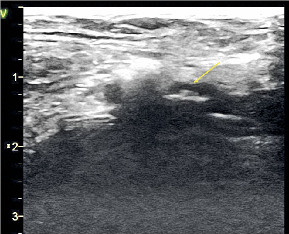 EuroIntervention tweet media