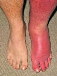 ipcgcs's tweet image. Spot the difference between Red Leg and Cellulitis 🤔Use antibiotics wisely! 💊#legsmatterweek   @Glos_CareNHS