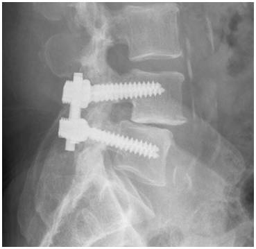 SanketS51478534's tweet image. Spinal Fusion Devices Market to hit $7,435 Million by 2022 : AMR 

More info @ bit.ly/2HYadKD

#SpinalFusionDevicesMarket #SpinalFusionDevices #SpinalDevices #medicaldevices #healthcare #marketresearch #latestnews #spinenews #spinebiology