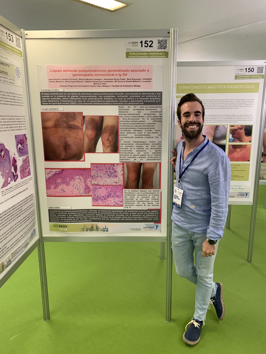rubii_93's tweet photo. Liquen amiloideo generalizado asociado a IgG4 #dermamalaga #AEDV2019 https://t.co/aiz1syJb7F