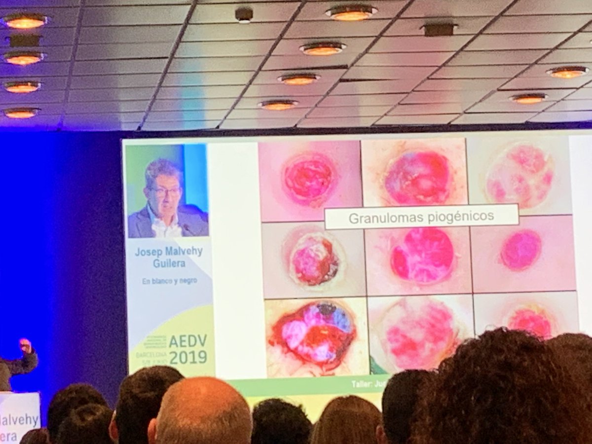rubii_93's tweet photo. Granulomas piogenos en dermatoscopia #AEDV2019 https://t.co/qhrIXkidoS