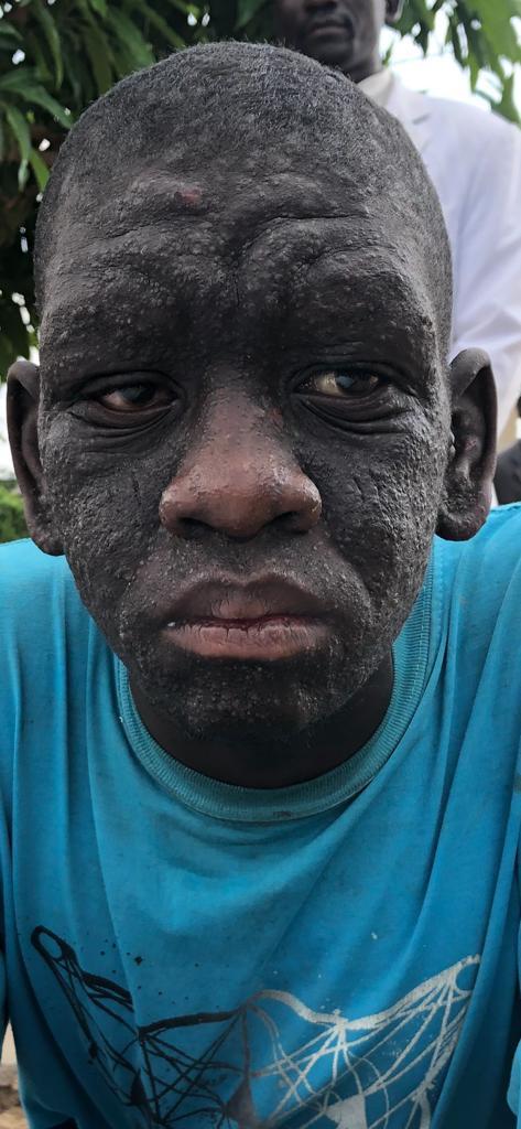 SoumahoroDesire's tweet photo. The power of the Blood of Jesus and now totally cured of leprosy and epilepsy by the decree of the TWO DREAMFULS PROPHETS OF THE LORD. #YouCannotConfuse https://t.co/gHlWBW67EO