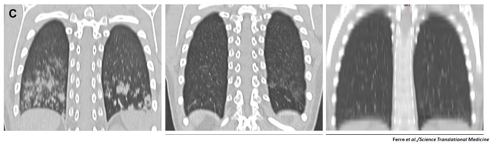 ScienceTM's tweet image. New research from the Lionakis lab reveals many patients with #APECED harbored previously-undiagnosed #pneumonitis, which was resolved with immunomodulatory drugs. @NIAIDNews fcld.ly/7t677o4