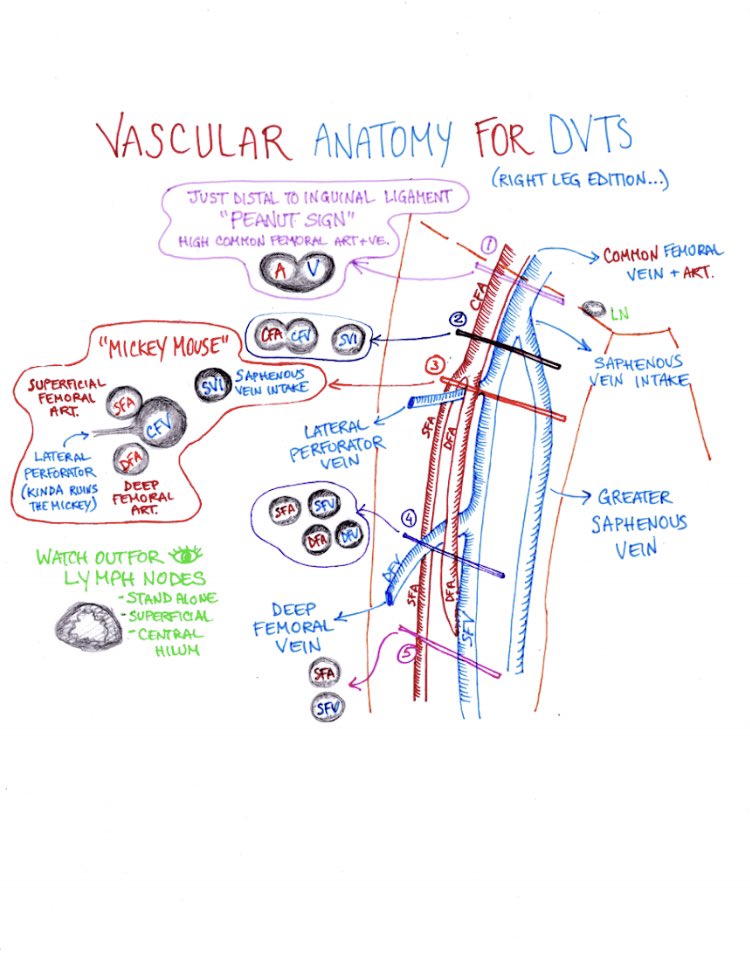 More  #POCUS class notes!
This is a map of landmarks for guidance while checking for DVTs.
Veins should be squishy and compressible (wall to wall touch) while adjacent arteries should be plump. If it doesn’t compress, suspect a thrombus! Thanks again to everyone at #NYUPOCUS!!
