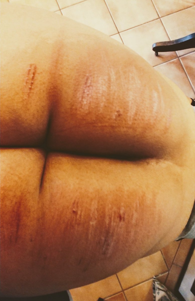 Dominurtrix's tweet photo. An incredibly satisfying day. Thank you cheeky girl π #caning #coldcaning #welts #bliss https://t.co/UFum4WSTpp