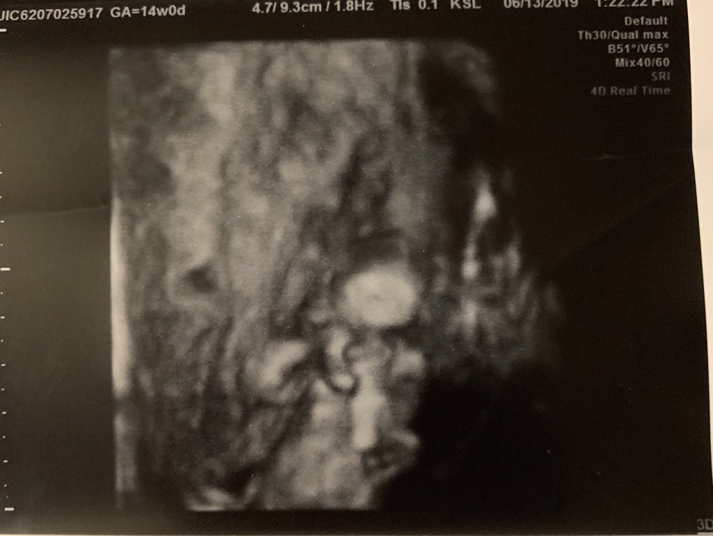 m_stover13's tweet photo. Annnnd... It’s a baby GIRL 😍💕😍 https://t.co/Rc67MEfKan