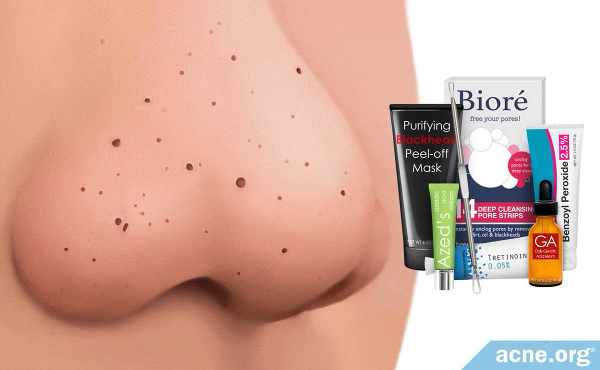 AcneOrg's tweet image. Clearing blackheads is a challenge. You can get them removed by a doctor, or Biore strips, but they usually refill after a couple of weeks. The best way to go is to prevent them in the first place with an effective anti-acne regimen. 

acne.org/how-to-clear-o…