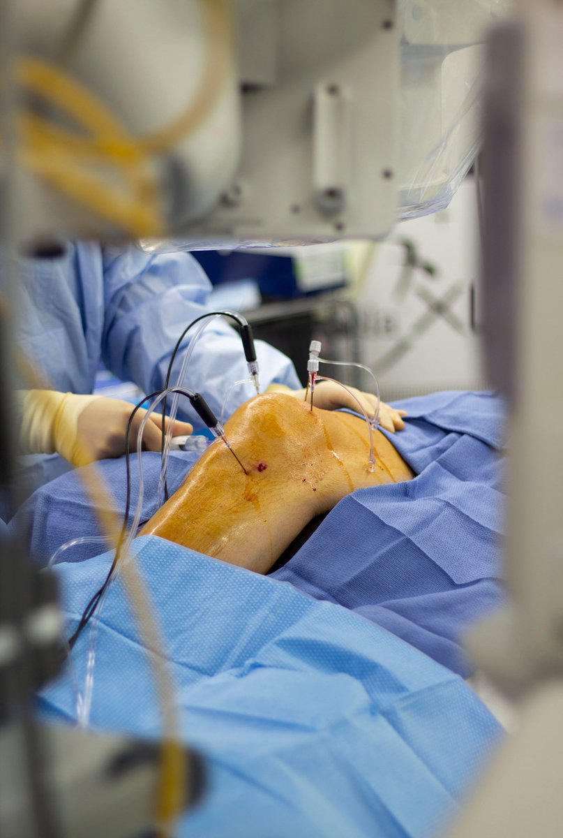 drchadstephens's tweet photo. The #COOLIEF procedure, or #radiofrequency ablation, treats chronic #pain by deactivating the nerves causing your pain. In this case, we treated the #knee but this procedure can also be used to treat #backpain or #osteoarthritis pain. https://t.co/KUJFYoiLRm