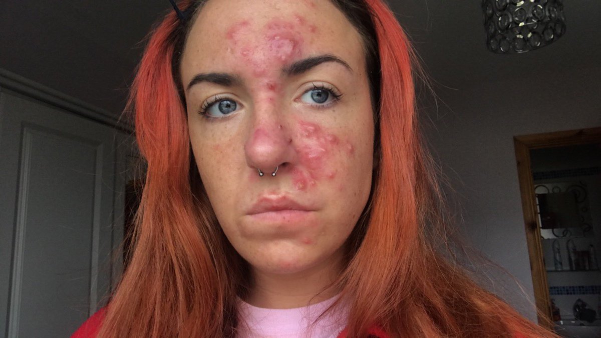 fzoley's tweet image. #AcneAwarenessMonth these photos were taken at different times over the last 2 years n it’s safe to say I probably will get acne at some stage again in my life because my skin is smoking crack but I will NEVER feel embarrassed or not good enough because of it again