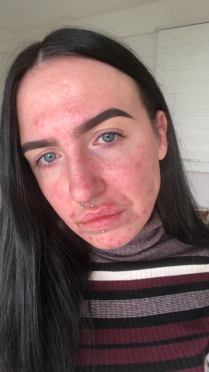 fzoley's tweet image. #AcneAwarenessMonth these photos were taken at different times over the last 2 years n it’s safe to say I probably will get acne at some stage again in my life because my skin is smoking crack but I will NEVER feel embarrassed or not good enough because of it again