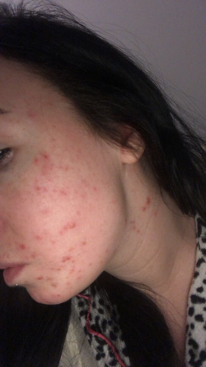 fzoley's tweet image. #AcneAwarenessMonth these photos were taken at different times over the last 2 years n it’s safe to say I probably will get acne at some stage again in my life because my skin is smoking crack but I will NEVER feel embarrassed or not good enough because of it again