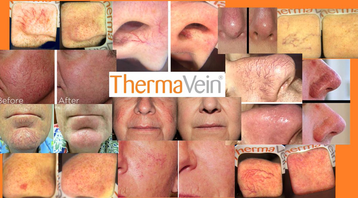 ThermaVein offers a treatment for thread/red veins that is safe, instant and effective. To see it in action call or email now for a free, no obligation demonstration. #veins #redveins #aesthetics