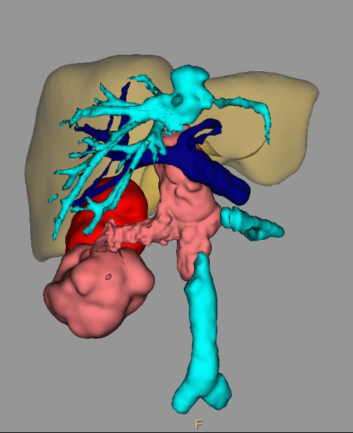 3d_maranon's tweet photo. 3D model of the kidney (blue) and inferior vena cava of a patient with a tumor (red) with an infiltration on the right renal vein and thrombosis in the inferior vena cava (red).  #HospitalMarañon3D FabLab team: @rupermac @calvoharo_ja @diegotrap @kn_ord https://t.co/shOmJzsZ7t