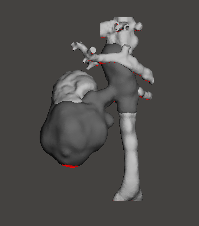 3d_maranon's tweet photo. 3D model of the kidney (blue) and inferior vena cava of a patient with a tumor (red) with an infiltration on the right renal vein and thrombosis in the inferior vena cava (red).  #HospitalMarañon3D FabLab team: @rupermac @calvoharo_ja @diegotrap @kn_ord https://t.co/shOmJzsZ7t