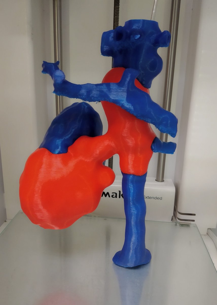 3d_maranon's tweet photo. 3D model of the kidney (blue) and inferior vena cava of a patient with a tumor (red) with an infiltration on the right renal vein and thrombosis in the inferior vena cava (red).  #HospitalMarañon3D FabLab team: @rupermac @calvoharo_ja @diegotrap @kn_ord https://t.co/shOmJzsZ7t