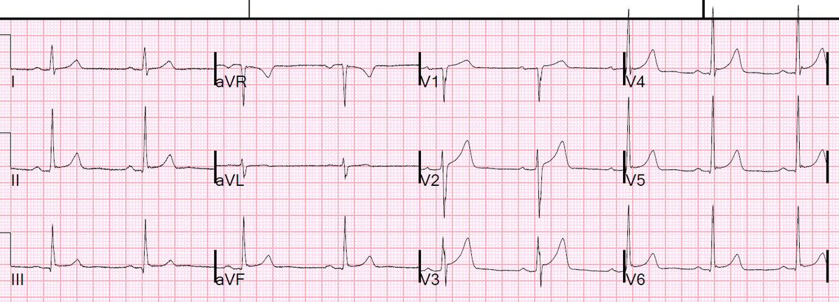 A 60-something with syncope  hqmeded-ecg.blogspot.com/2019/06/a-60-s…