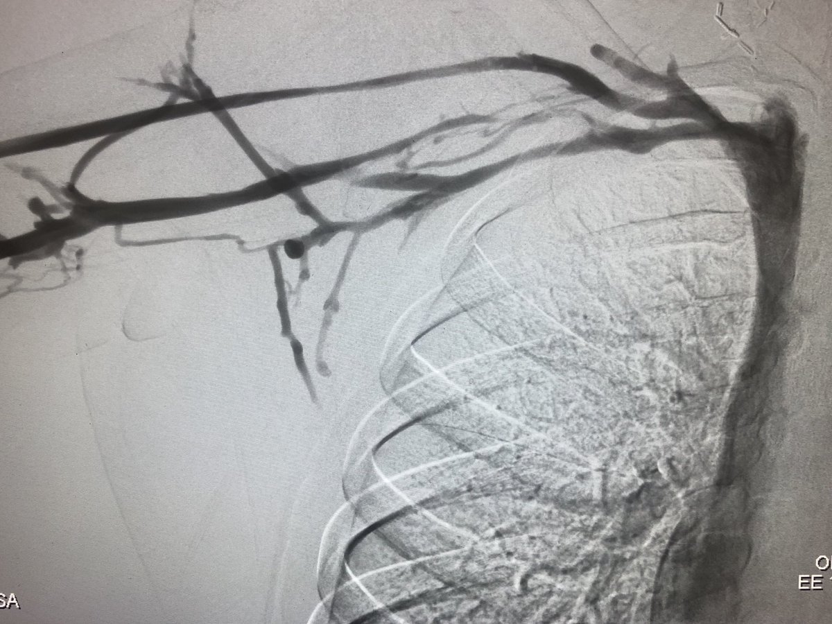 DrAliAzizzadeh's tweet photo. Right arm #venogram after #lysis and #decompression for #venous #ThoracicOutletSyndrome #TOS #effortthrombosis #DVT #PagetSchroetter #MultidisciplinaryCare #VIR #VascularSurgery @doctorhgl @CedarsSinai https://t.co/ougmEmS63k