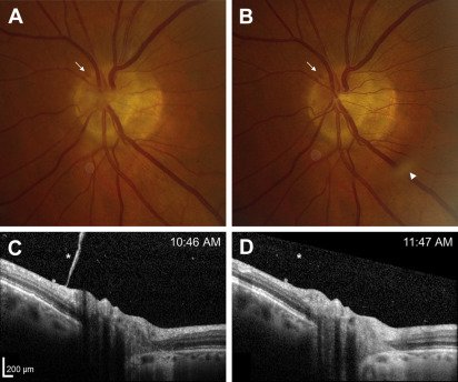 AAOjournal's tweet photo. Featured Pictures &amp; Perspectives: Separation Anxiety https://t.co/5UEBfqxNmJ #Ophthalmology #Retina https://t.co/1veXjaCm8q