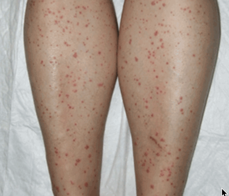 QUESTION FOR THE COMMUNITY: has anyone else developed purpura on their lower legs? For those that don’t know it’s a red dot like rash that often joins together. It comes and goes. Thank everyone 😊