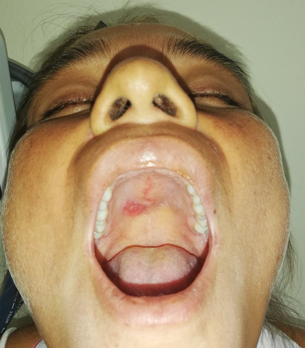 pg_saavedra's tweet photo. A 31 yo female patient with mucosal ulceration in relationship with active systemic lupus erythematosus
#drpubliosaavedrareumatólogo #therheumatologydoctor #rheumatology #Reumatología #MEDELLÍN #lupus #sle #systemiclupus https://t.co/wA0txzibrQ