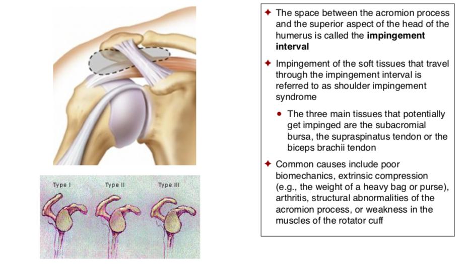 AnatomyStudies's tweet photo. Shoulder Impingement Syndrome
Β©Anatomy Studies for Yoga Teachers. All Rights Reserved.
#FAA2019 #functionalanatomyacademy #functionalanatomy #anatomystudies #anatomyforyogateachers #asfyt2019 #teachtolearn #learntoteach #yogaishappiness #yogateacher #asfyt #yogaanatomy https://t.co/lWR9MC1udP