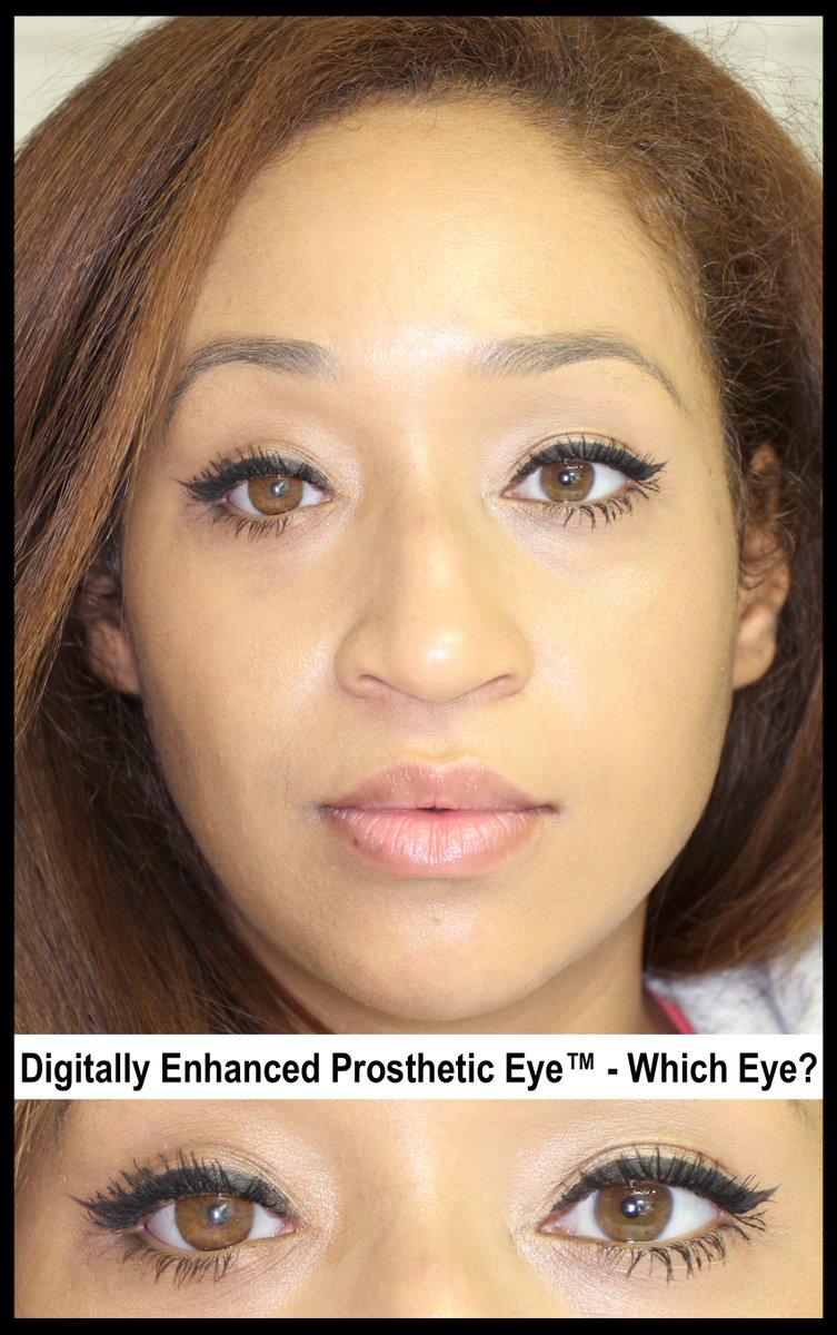 Another successful treatment of Congenital Microphthalmia with Stenting Therapy, which allowed us to expand tissues of her right eye to match her companion eye, and she is now able to comfortably wear Scleral Shell Prosthesis!

#ProstheticEye #ArtificialEye #BestProstheticEyes