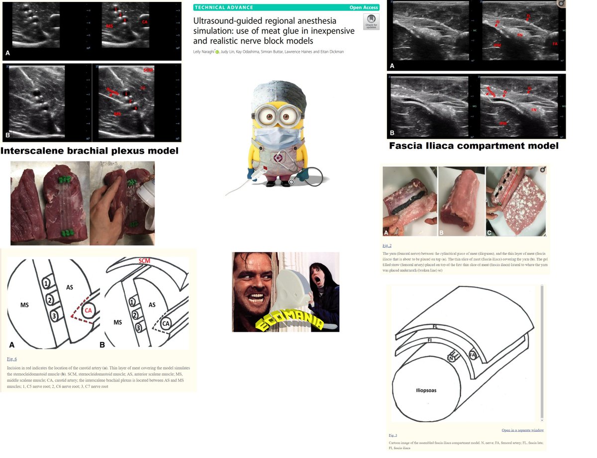 #FOAMus Ultrasound-guided regional anesthesia simulation: use of meat glue in inexpensive and realistic nerve block models #POCUS #PEM #FOAMed 
ncbi.nlm.nih.gov/pmc/articles/P…   AMAZING!!!