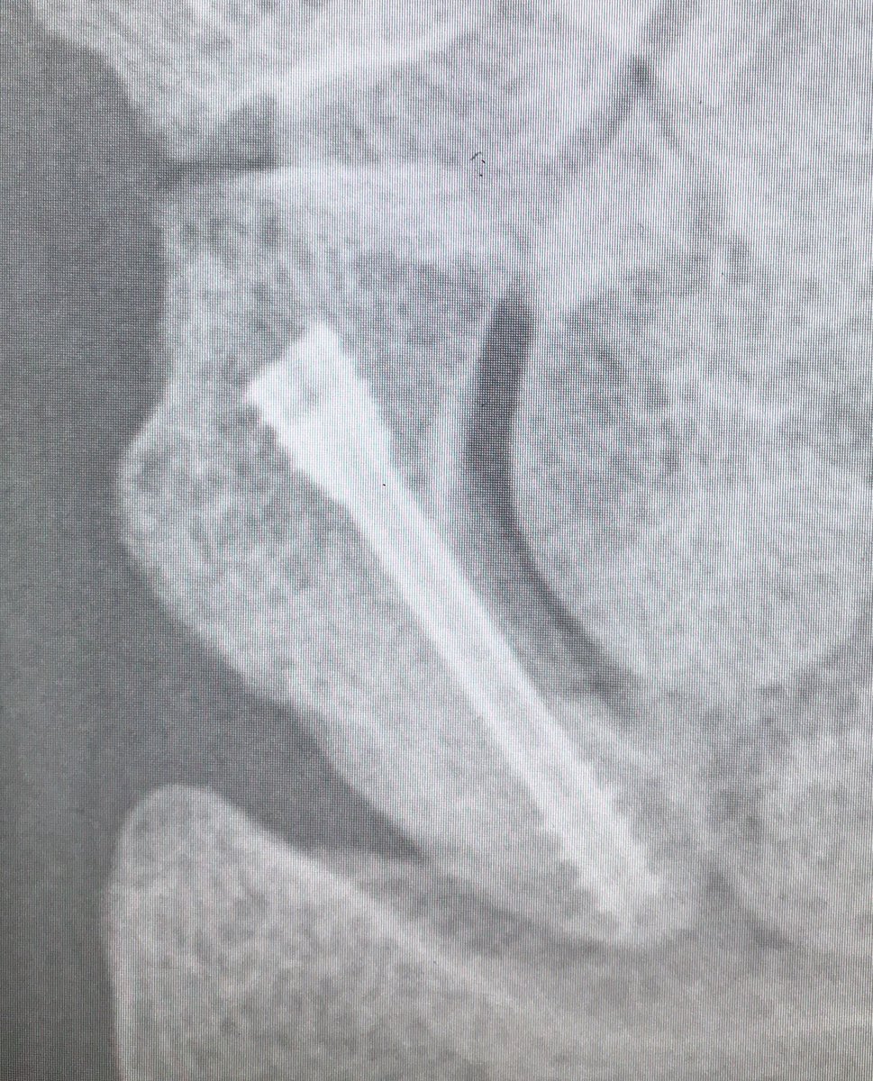 CY_Hand's tweet photo. Excellent #HandClinics issue on the Current Concepts and Controversies in Scaphoid Fracture Management https://t.co/VotFOQfBZO https://t.co/dwFVtzyPtt