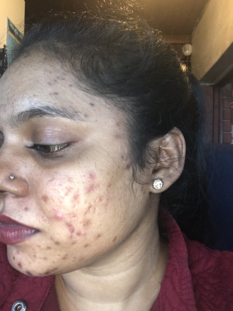 PrabashneR's tweet photo. @KailLowry This is my accutane story. People called me ugly but today I have the best skin. 2 years off accutane https://t.co/BURiHeAxhB