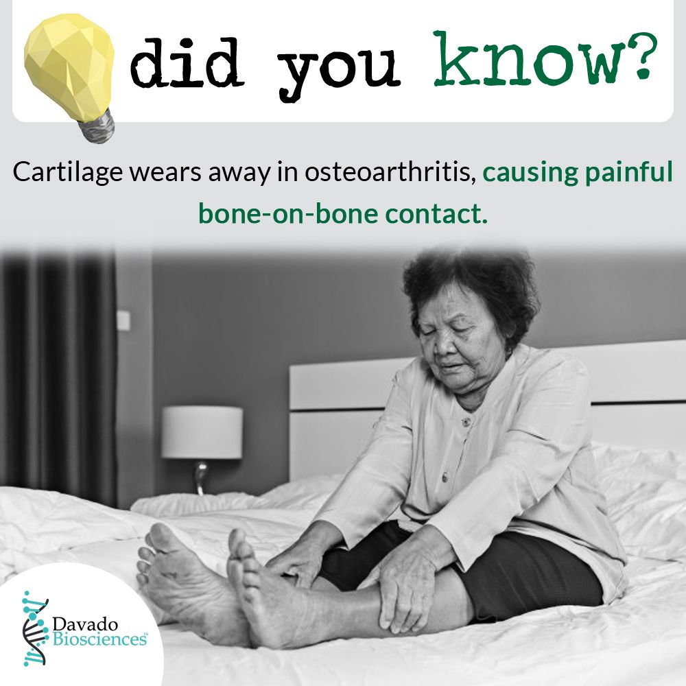 DavadoBio's tweet photo. Cartilage wears away in #osteoarthritis, causing painful bone-on-bone contact. https://t.co/CkA4xnpyjI