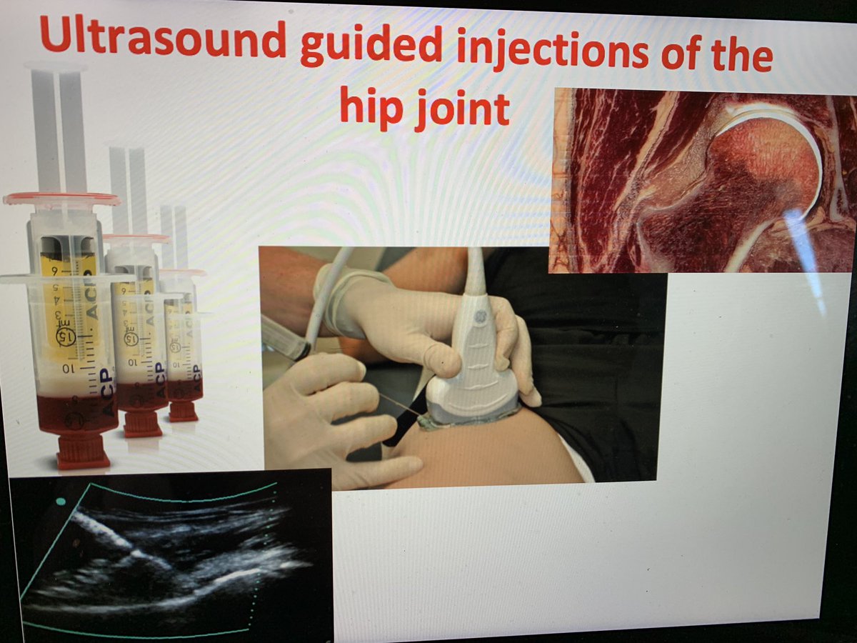 SURESHSUDULA's tweet photo. Looking forward to presenting at ‘The Adult Hip Patient’ Rehab course, University College Hospital London this AM. Should be an interesting discussions about inj options for hip pain patients+live USG Hip joint injection on a patien @function2fitnes @Orca_Medical @trbchemedicauk https://t.co/VDqO3G02t2