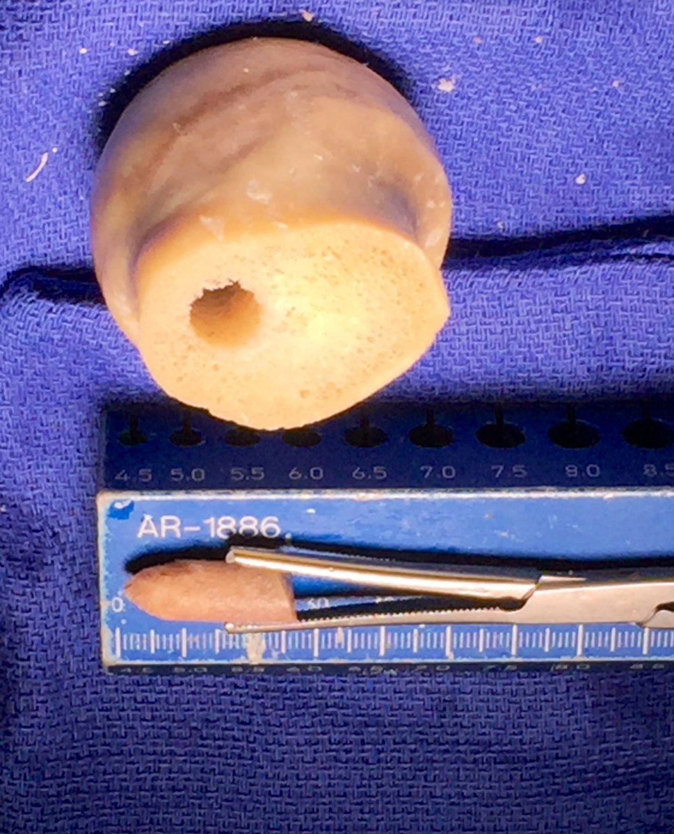ShaeSloan2's tweet photo. Femoral Head Bone Graft; use core reamer and start drilling into femoral neck and exit cortex; cut to appropriate length and shape like #2 pencil; used in ACL revision cases https://t.co/6MfIk2KILl