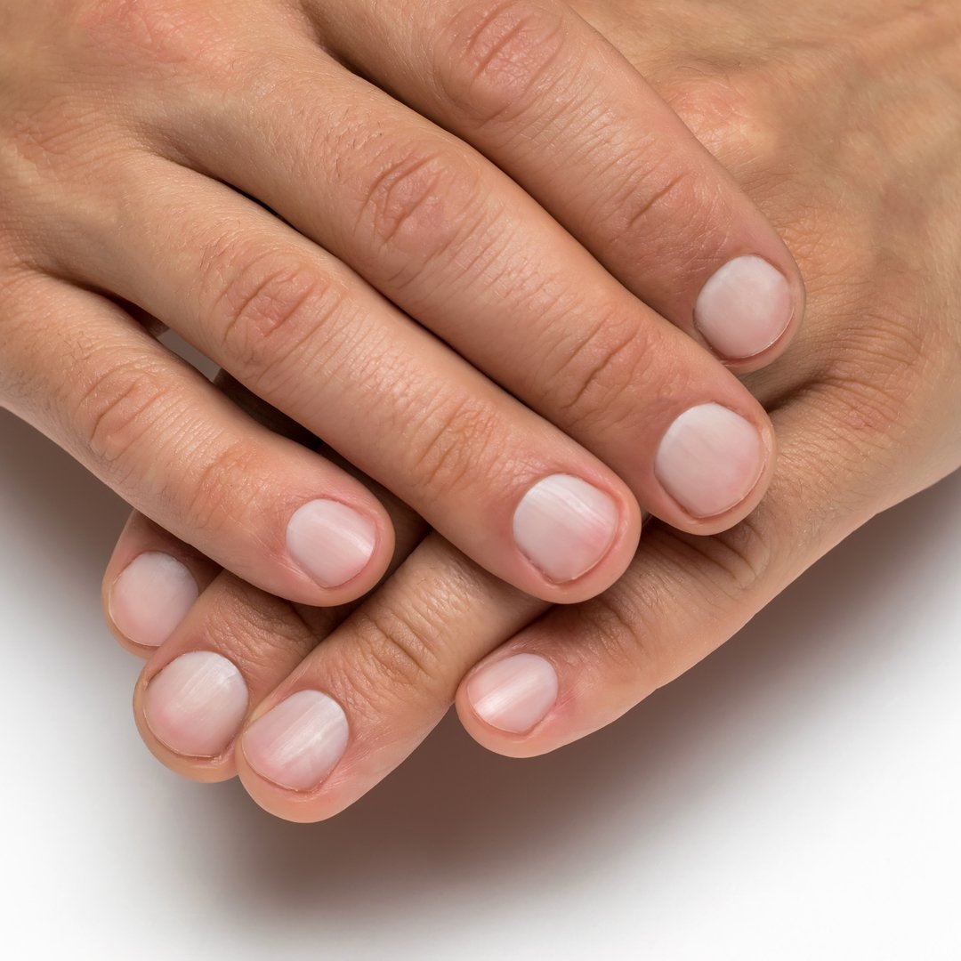 Инфекция ногтевой пластины. Поперечны борозды борейли. Псориатическая дистрофия ногтей. Подногтевой гиперкератоз. Твердые ногти на руках.