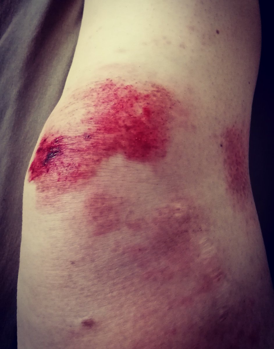 nineviaene's tweet photo. Message to #MontVentoux : See you in 1⃣3⃣ days, you better be good to me!
#wrist #knee #injury #motivation #believe #NeverGiveUp #innerStrength #determination #FallDownSevenTimesStandUpEight #KlimmenVoorKakuma https://t.co/1ahjWxvvyw