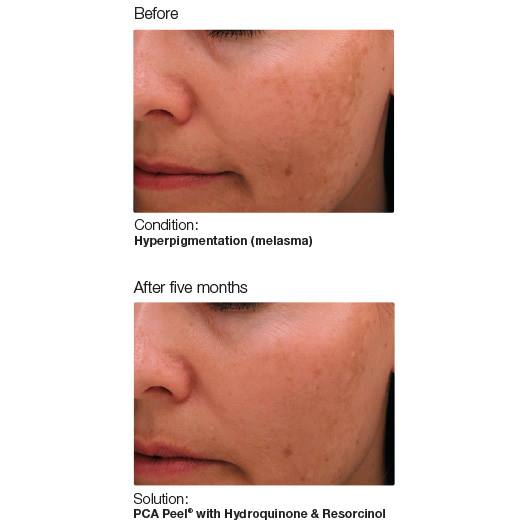 Lighten hyperpigmentation, treat acne, rosacea and diminish wrinkes with a PCA Skin Peel today!