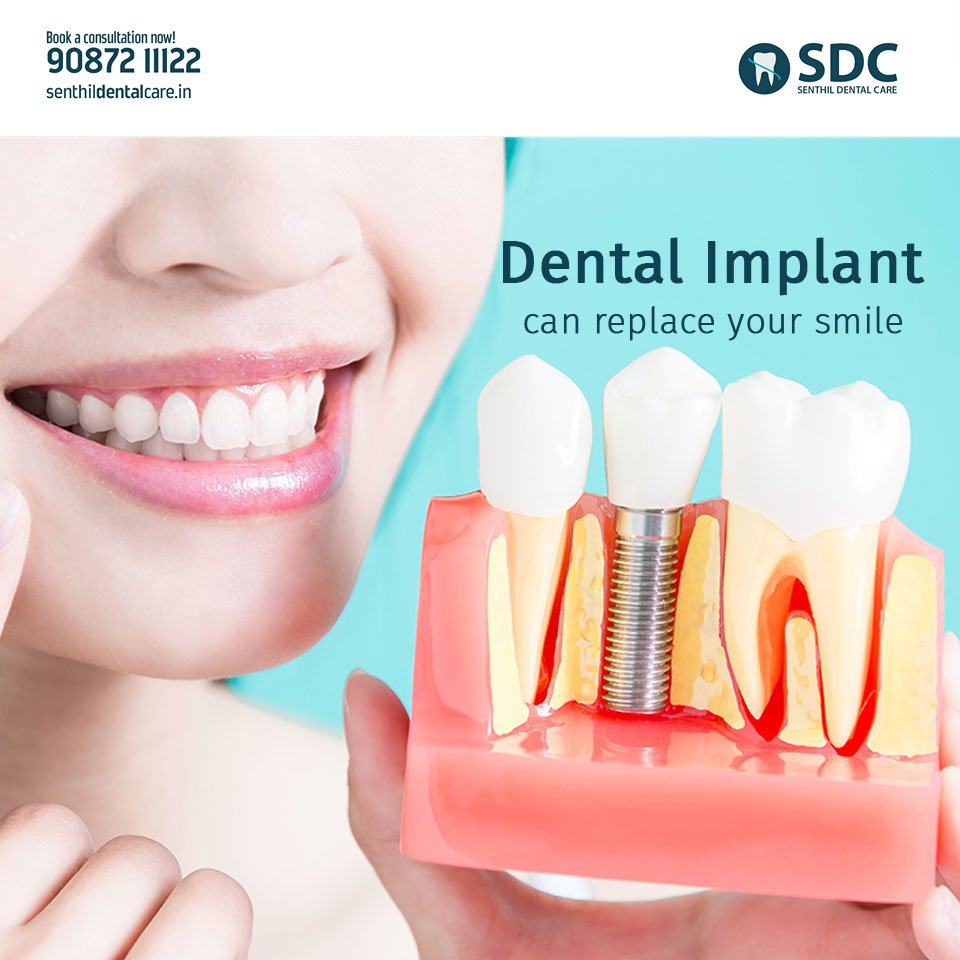 senthildental's tweet photo. Missing teeth can make you feel conscious all the time. But no more. With #dental #implants get yourself a perfect smile through complete tooth replacement that looks, feels and functions just like natural teeth.

Visit: https://t.co/aTVuXYHUBF
Call us: +91 9087211122 https://t.co/G9kZxjGkiZ
