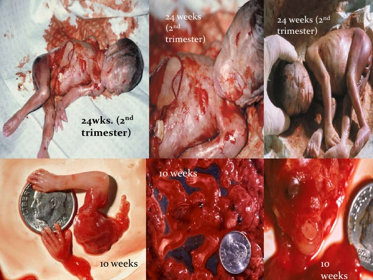 TQ_Design's tweet photo. @doctor_oxford 24 Weeks. You people sicken me. https://t.co/fpJibKEdhk