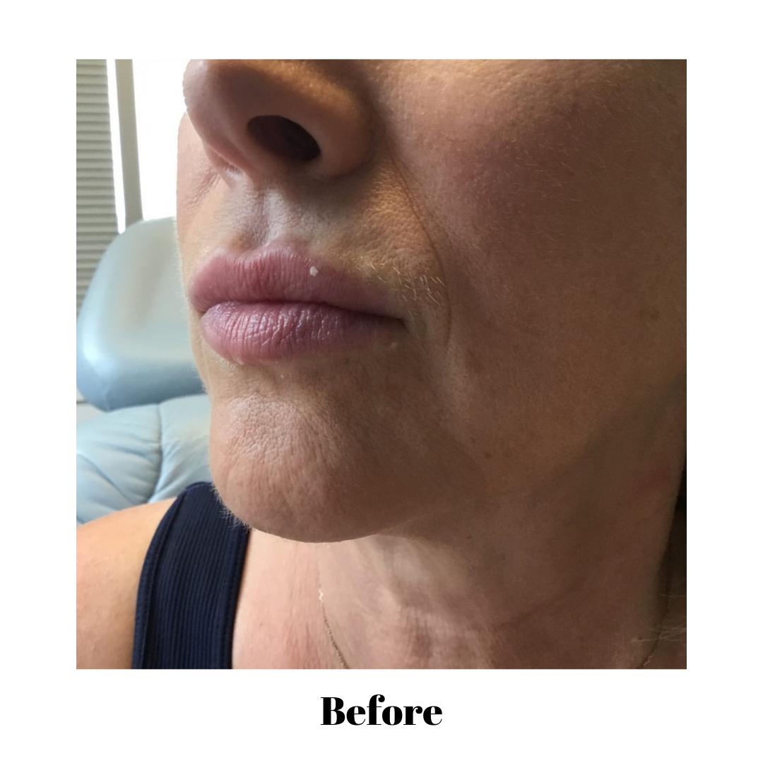 johnvinemd's tweet image. Want your lips to look like this after one treatment? 👄👄 Our patient came in ready for her summer lips ☀️ , and we got her where she wanted with one syringe 💉 of Restylane defyne 👄👄 Call us at 609-799-6222. #plumplips #plumpedlips #lookgoodforless #summerbody #runway
