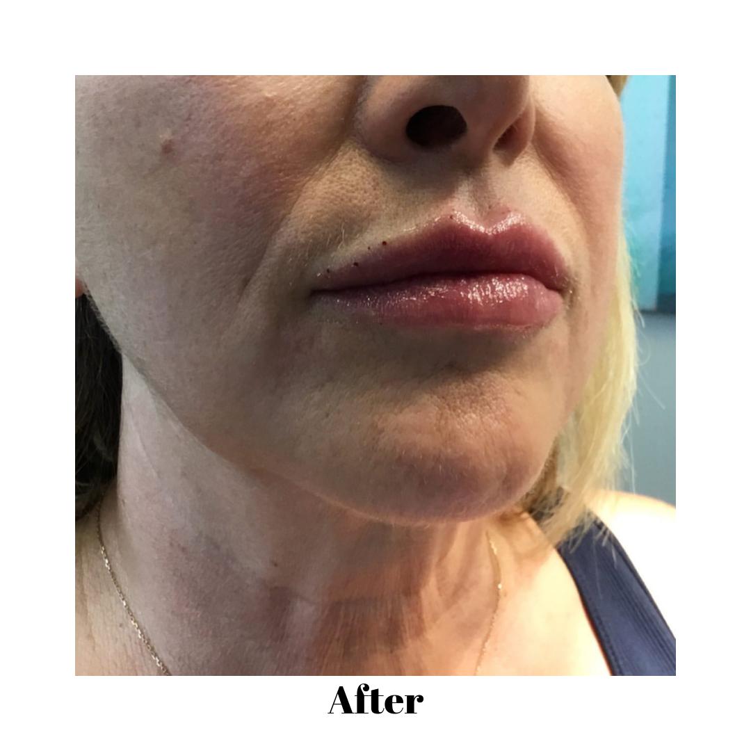 johnvinemd's tweet image. Want your lips to look like this after one treatment? 👄👄 Our patient came in ready for her summer lips ☀️ , and we got her where she wanted with one syringe 💉 of Restylane defyne 👄👄 Call us at 609-799-6222. #plumplips #plumpedlips #lookgoodforless #summerbody #runway