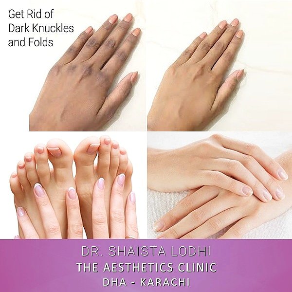 SLACPK's tweet photo. Lighten Dark Knuckles and Folds.
The Aesthetics Clinic.
For appointments please call 0321-1225719 021-38883275 DHA – Karachi.
#DrShaistaLodhi #ShaistaLodhi #darkknuckles #armpit #ankle #elbow #knuckles #darkspots #underarms #knees @IamShaistaLodhi https://t.co/c06WXIxsWQ