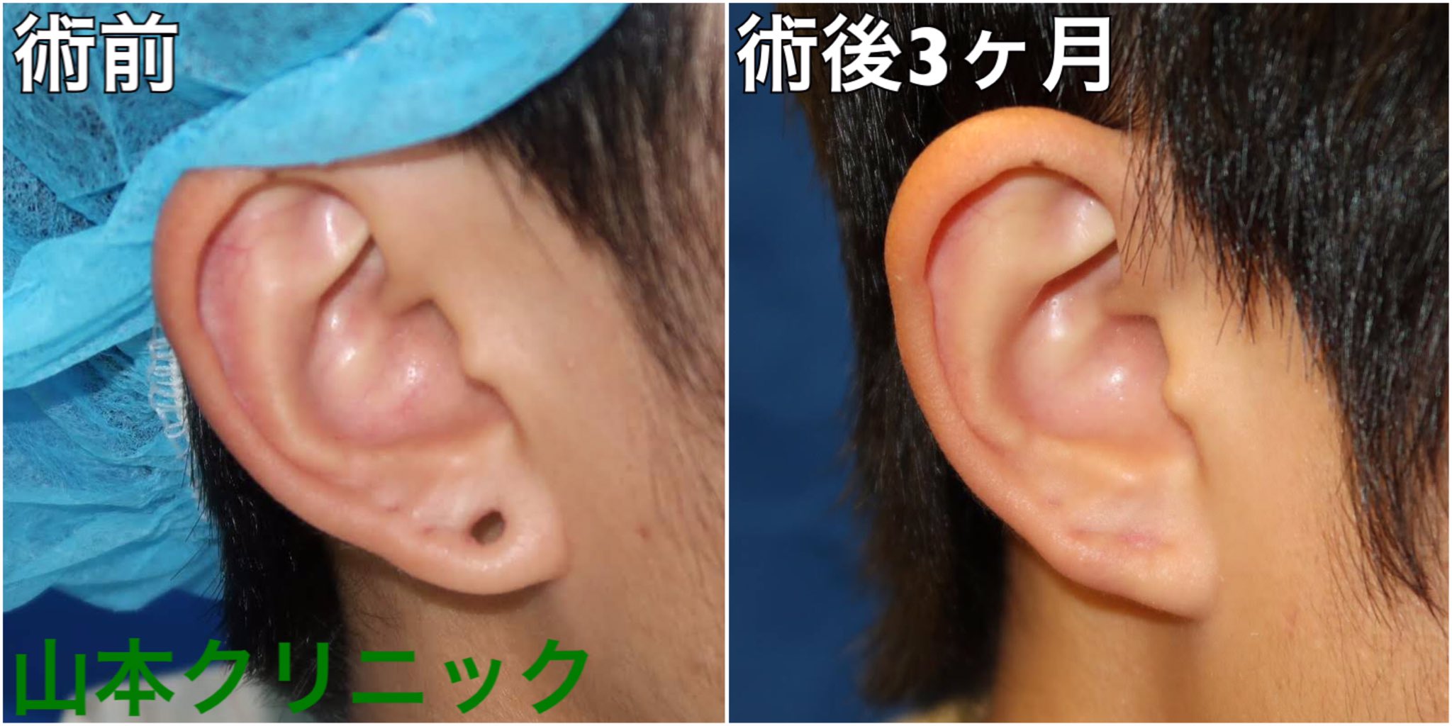 煙突 保存する 配置 ピアス 穴 修正 Aska Traffic Service Jp 煙突 保存する 配置 ピアス 穴 修正 Aska Traffic Service Jp