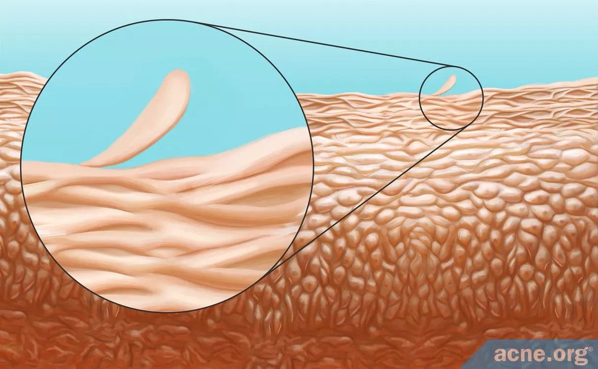 AcneOrg's tweet image. Ever wondered how exfoliation can help with acne? Here's how. 

Most important: Chemically exfoliating with glycolic acid or salicylic acid keeps the skin clear better than physically exfoliating with things like rotating brushes or microdermabrasion. 

acne.org/how-exfoliatio…