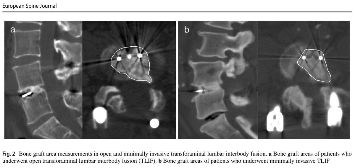 EurSpineJournal's tweet photo. Is there any difference in the interbody bone #graft area and fusion rate between #minimallyinvasive and traditional #open #transforaminal #lumbar interbody #fusion?
https://t.co/JtXCrDacyS https://t.co/2ApMwPg6tf