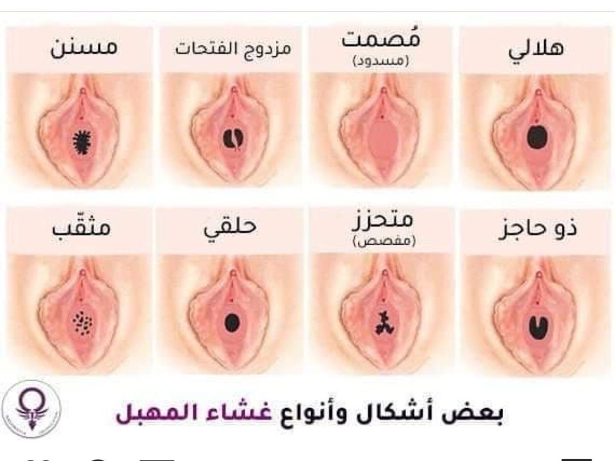 هـبـة النـائـب HIBA Alnnayib on X: _ثمانية انواع لشكل غشاء المهبل🔞  📌هلالي-مُصمت-مزدوج الفتحات-مسنن-ذو حاجز-محتزز-حلقي-مثقّب. 4انواع مطاطي اي  لايخرج منه دماً حينها تبتلى الانثى بما خلقت وبما تمتلك من مصيبة قد تضطر  قسراً