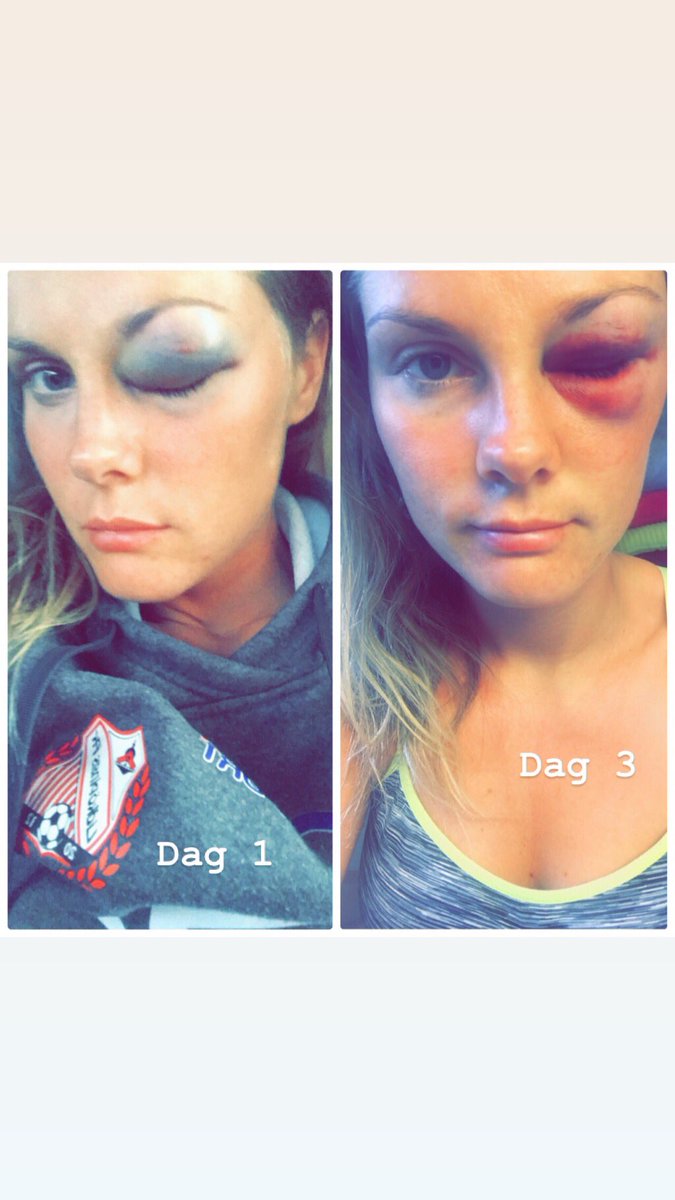 Längtar efter att kunna se världen med två ögon igen och va tillbaka på planen ⚽️🖤❤️👊
